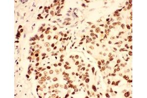 IHC-P: BRCA1 antibody testing of human breast cancer tissue (BRCA1 抗体  (AA 1661-1863))