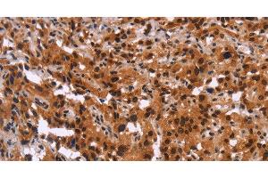 Immunohistochemistry of paraffin-embedded Human thyroid cancer using GPR124 Polyclonal Antibody at dilution of 1:40 (GPR124 抗体)
