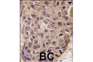 Formalin-fixed and paraffin-embedded human breast carcinoma tissue reacted with OAS1 antibody (C-term), which was peroxidase-conjugated to the secondary antibody, followed by DAB staining. (OAS1 抗体  (C-Term))