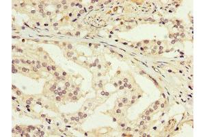 IHC image of ABIN7166949 diluted at 1:200 and staining in paraffin-embedded human prostate cancer performed on a Leica BondTM system. (GDI1 抗体  (AA 35-170))