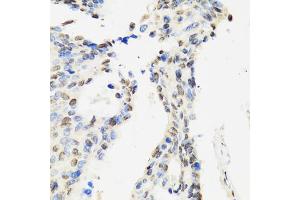 Immunohistochemistry of paraffin-embedded human rectal cancer using CCAR2 antibody (ABIN2563550) at dilution of 1:100 (40x lens). (CCAR2 抗体)