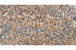 Immunohistochemistry of paraffin-embedded Human liver cancer tissue using ANXA10 Polyclonal Antibody at dilution 1:35 (Annexin a10 抗体)