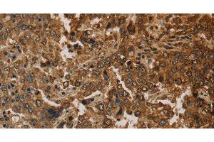 Immunohistochemistry of paraffin-embedded Human liver cancer using CK-16 Polyclonal Antibody at dilution of 1:30 (KRT16 抗体)
