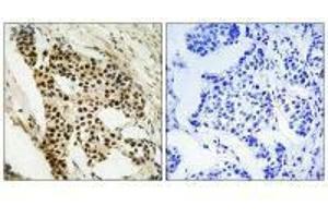 Immunohistochemistry analysis of paraffin-embedded human breast carcinoma tissue using MAPKAPK2 (Ab-272) antibody. (MAPKAP Kinase 2 抗体  (Ser272))