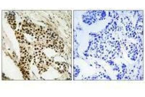 Immunohistochemistry analysis of paraffin-embedded human breast carcinoma tissue using MAPKAPK2 (Ab-272) antibody.