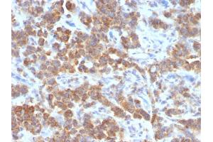 Formalin-fixed, paraffin-embedded human Parathyroid Mass stained with TNFS15 / VEGI Monoclonal Antibody (VEGI /1283). (TNFSF15 抗体)