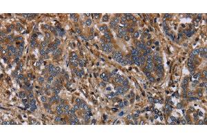 Immunohistochemistry of paraffin-embedded Human liver cancer using FLNA Polyclonal Antibody at dilution of 1:40 (Filamin A 抗体)