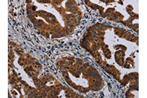 The image on the left is immunohistochemistry of paraffin-embedded Human gastic cancer tissue using ABIN7191351(MAGEB3 Antibody) at dilution 1/20, on the right is treated with synthetic peptide. (MAGEB3 抗体)