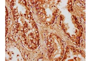 IHC image of ABIN7148132 diluted at 1:500 and staining in paraffin-embedded human prostate cancer performed on a Leica BondTM system. (CCDC6 抗体  (AA 347-440))