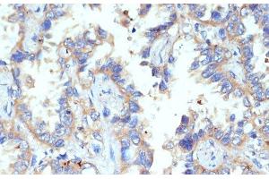 Immunohistochemistry of paraffin-embedded Human lung cancer using CD47 Polyclonal Antibody at dilution of 1:200 (40x lens). (CD47 抗体)