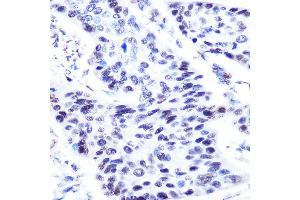 Immunohistochemistry of paraffin-embedded human esophageal cancer using p63 antibody (ABIN3023011, ABIN3023012, ABIN3023013, ABIN1513632 and ABIN6219346) at dilution of 1:50 (40x lens). (p63 抗体  (AA 421-680))
