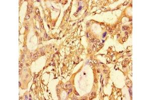 Immunohistochemistry of paraffin-embedded human pancreatic cancer using ABIN7172704 at dilution of 1:100 (SUPT3H/SPT3 抗体  (AA 1-328))