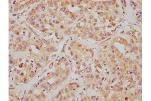 IHC image of ABIN7127540 diluted at 1:112. (Recombinant HDAC6 抗体)