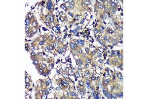 Immunohistochemistry of paraffin-embedded Human liver cancer using SENP1 Rabbit pAb (ABIN6132646, ABIN6147534, ABIN6147536 and ABIN6216945) at dilution of 1:100 (40x lens). (SENP1 抗体  (AA 220-420))