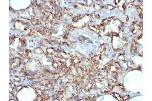 Formalin-fixed, paraffin-embedded human Angiosarcoma stained with CD31 antibody (JC/70A) (CD31 抗体)