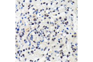 Immunohistochemistry of paraffin-embedded human oophoroma using Cullin 3 antibody (ABIN7266543) at dilution of 1:100 (40x lens). (Cullin 3 抗体)