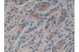DAB staining on IHC-P; Samples: Human Prostate cancer Tissue (CD1e 抗体  (AA 39-276))