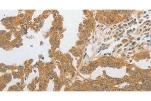 Immunohistochemistry of paraffin-embedded Human ovarian cancer tissue using GRIN2C Polyclonal Antibody at dilution 1:80 (GRIN2C 抗体)