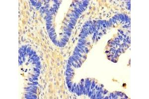 Immunohistochemistry of paraffin-embedded human ovarian cancer using ABIN7174304 at dilution of 1:100 (USP3 抗体  (C-Term))