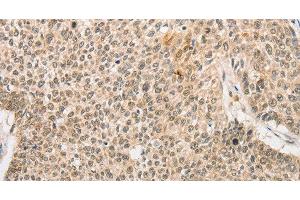 Immunohistochemistry of paraffin-embedded Human lung cancer tissue using RPL26L1 Polyclonal Antibody at dilution 1:30 (RPL26L1 抗体)