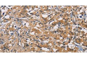 Immunohistochemistry of paraffin-embedded Human thyroid cancer tissue using PIKFYVE Polyclonal Antibody at dilution 1:50 (PIKFYVE 抗体)