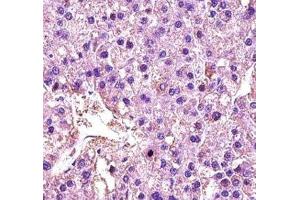 LDHA antibody immunohistochemistry analysis in formalin fixed and paraffin embedded human hepatocarcinoma (Lactate Dehydrogenase A 抗体  (AA 204-232))