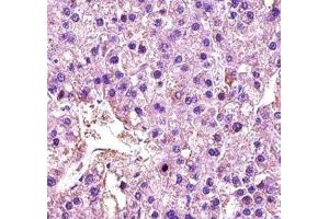 LDHA antibody immunohistochemistry analysis in formalin fixed and paraffin embedded human hepatocarcinoma