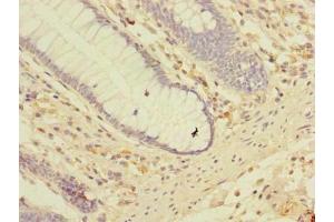 Immunohistochemistry of paraffin-embedded human colon cancer using ABIN7158150 at dilution of 1:100 (LRRC2 抗体  (AA 1-371))
