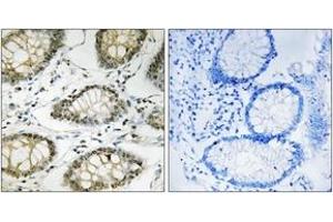 Immunohistochemistry analysis of paraffin-embedded human colon carcinoma, using ATR (Phospho-Ser428) Antibody. (ATR 抗体  (pSer428))