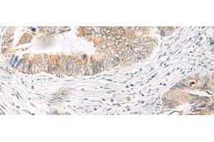 Immunohistochemistry of paraffin-embedded Human colorectal cancer tissue using IDUA Polyclonal Antibody at dilution of 1:35(x200) (IDUA 抗体)