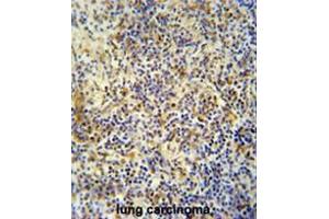 KRI1 antibody (N-term) immunohistochemistry analysis in formalin fixed and paraffin embedded human lung carcinoma followed by peroxidase conjugation of the secondary antibody and DAB staining. (KRI1 抗体  (N-Term))