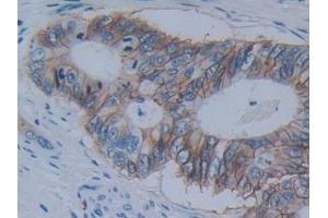 Detection of CDH17 in Human Colorectal cancer Tissue using Polyclonal Antibody to Cadherin 17 (CDH17) (LI Cadherin 抗体  (AA 67-351))