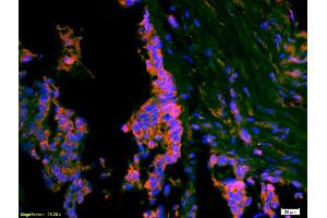 Formalin-fixed and paraffin-embedded rat brain labeled with Anti-ATF3 Polyclonal Antibody, Unconjugated (ABIN669561) 1:200, overnight at 4°C, The secondary antibody was Goat Anti-Rabbit IgG, Cy3 conjugated used at 1:200 dilution for 40 minutes at 37°C.