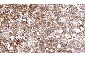 ABIN6279837 at 1/100 staining Human liver cancer tissue by IHC-P. (SLC6A20 抗体  (Internal Region))