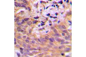 Immunohistochemical analysis of CDKL2 staining in human breast cancer formalin fixed paraffin embedded tissue section. (CDKL2 抗体  (Center))