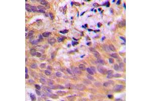 Immunohistochemical analysis of CDKL2 staining in human breast cancer formalin fixed paraffin embedded tissue section.