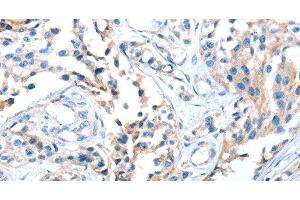 Immunohistochemistry of paraffin-embedded Human esophagus cancer using AOX1 Polyclonal Antibody at dilution of 1:65 (AOX1 抗体)