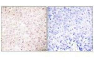 Immunohistochemical analysis of paraffin-embedded human breast carcinoma tissue using P300/CBP antibody. (EP3/CREBBP 抗体)