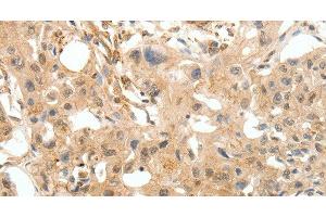 Immunohistochemistry of paraffin-embedded Human breast cancer tissue using COL4A1 Polyclonal Antibody at dilution 1:30 (COL4A1 抗体)