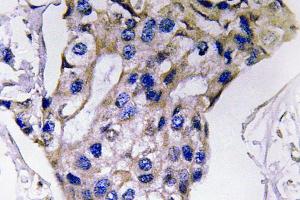 Immunohistochemistry (IHC) analyzes of IL-5 antibody in paraffin-embedded human breast carcinoma tissue. (IL-5 抗体)