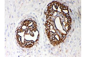 Anti- PKM2 Picoband antibody, IHC(P) IHC(P): Human Mammary Cancer Tissue