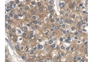 DAB staining on IHC-P; Samples: Human Prostate cancer Tissue (ALDOA 抗体  (AA 18-273))