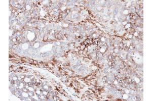 IHC-P Image Immunohistochemical analysis of paraffin-embedded human serous ovarian cancer, using AKAP12, antibody at 1:100 dilution. (AKAP12 抗体  (C-Term))