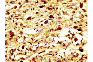 IHC image of ABIN7160588 diluted at 1:800 and staining in paraffin-embedded human melanoma performed on a Leica BondTM system. (MYH7 抗体  (AA 1802-1915))