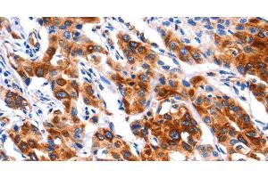 Immunohistochemistry of paraffin-embedded Human lung cancer tissue using SEPT4 Polyclonal Antibody at dilution 1:50 (Septin 4 抗体)