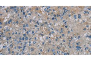 Immunohistochemistry of paraffin-embedded Human liver cancer tissue using PGLYRP1 Polyclonal Antibody at dilution 1:40 (PGLYRP1 抗体)
