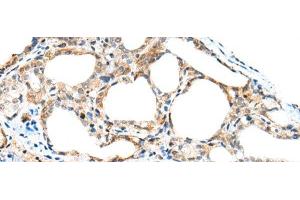 Immunohistochemistry of paraffin-embedded Human thyroid cancer tissue using SPACA3 Polyclonal Antibody at dilution of 1:45(x200) (SPACA3 抗体)
