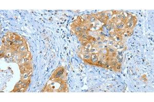 Immunohistochemistry of paraffin-embedded Human cervical cancer using ANXA3 Polyclonal Antibody at dilution of 1:35 (Annexin A3 抗体)