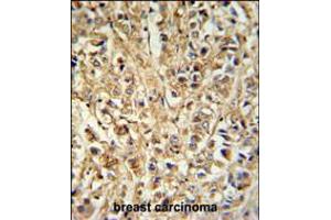 DDX6 Antibody IHC analysis in formalin fixed and paraffin embedded breast carcinoma followed by peroxidase conjugation of the secondary antibody and DAB staining.