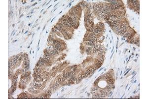 Immunohistochemical staining of paraffin-embedded Human liver tissue using anti-ACAT2 mouse monoclonal antibody. (ACAT2 抗体)